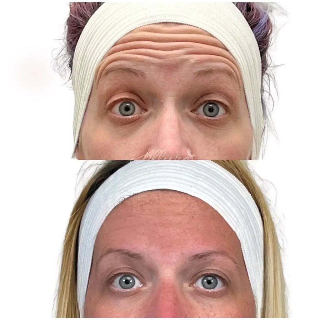 Botox Before and After