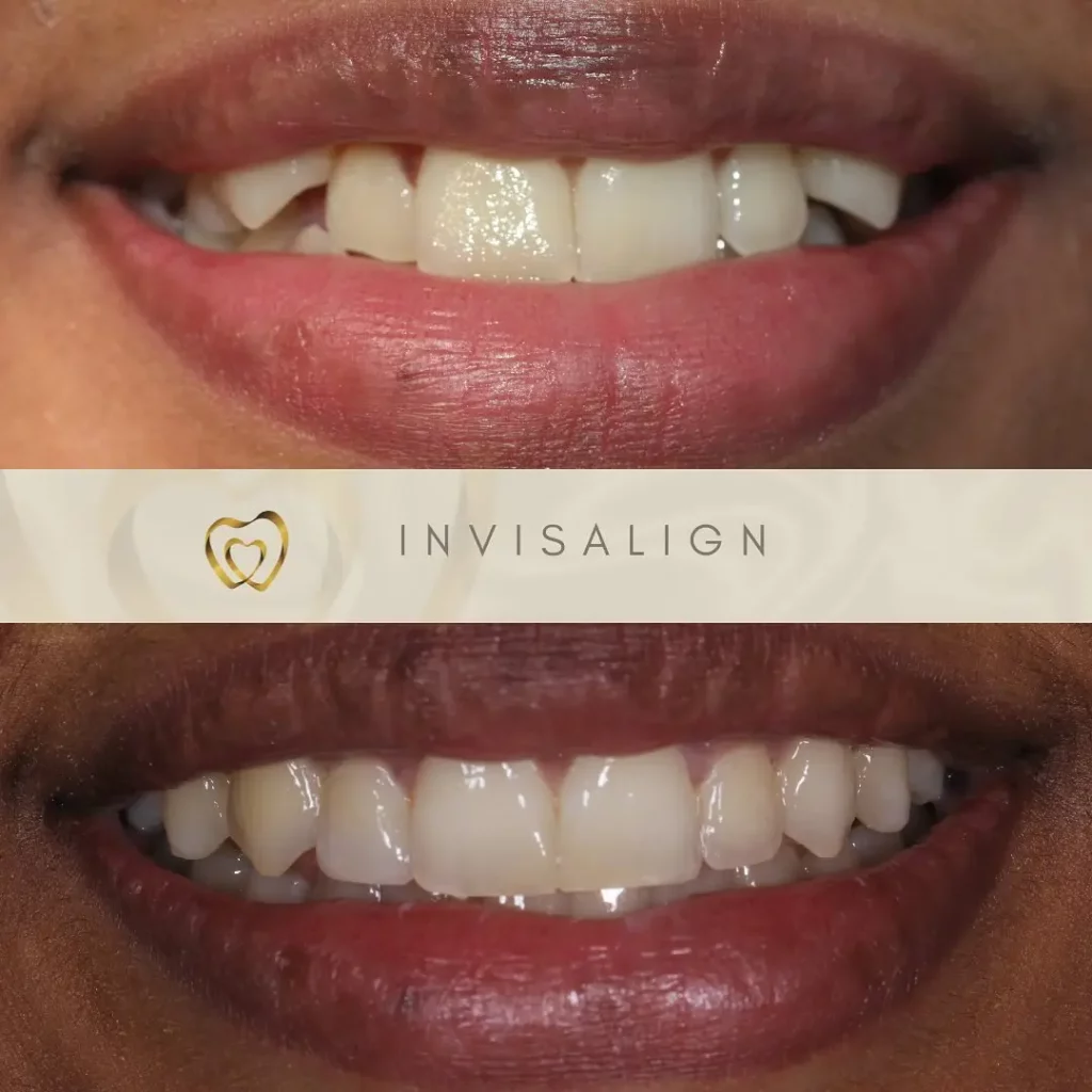 Invisalign Before and After