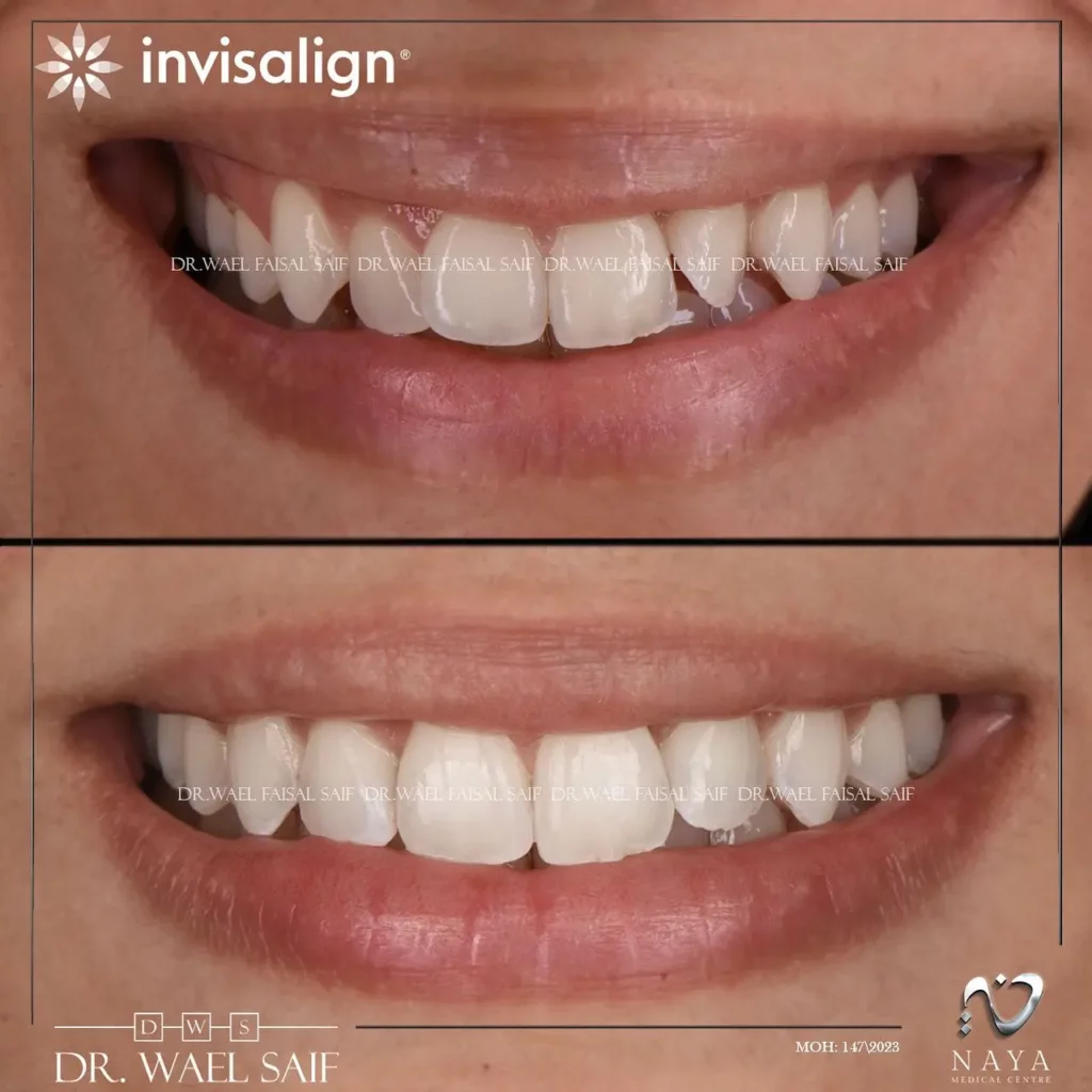 Invisalign Before and After