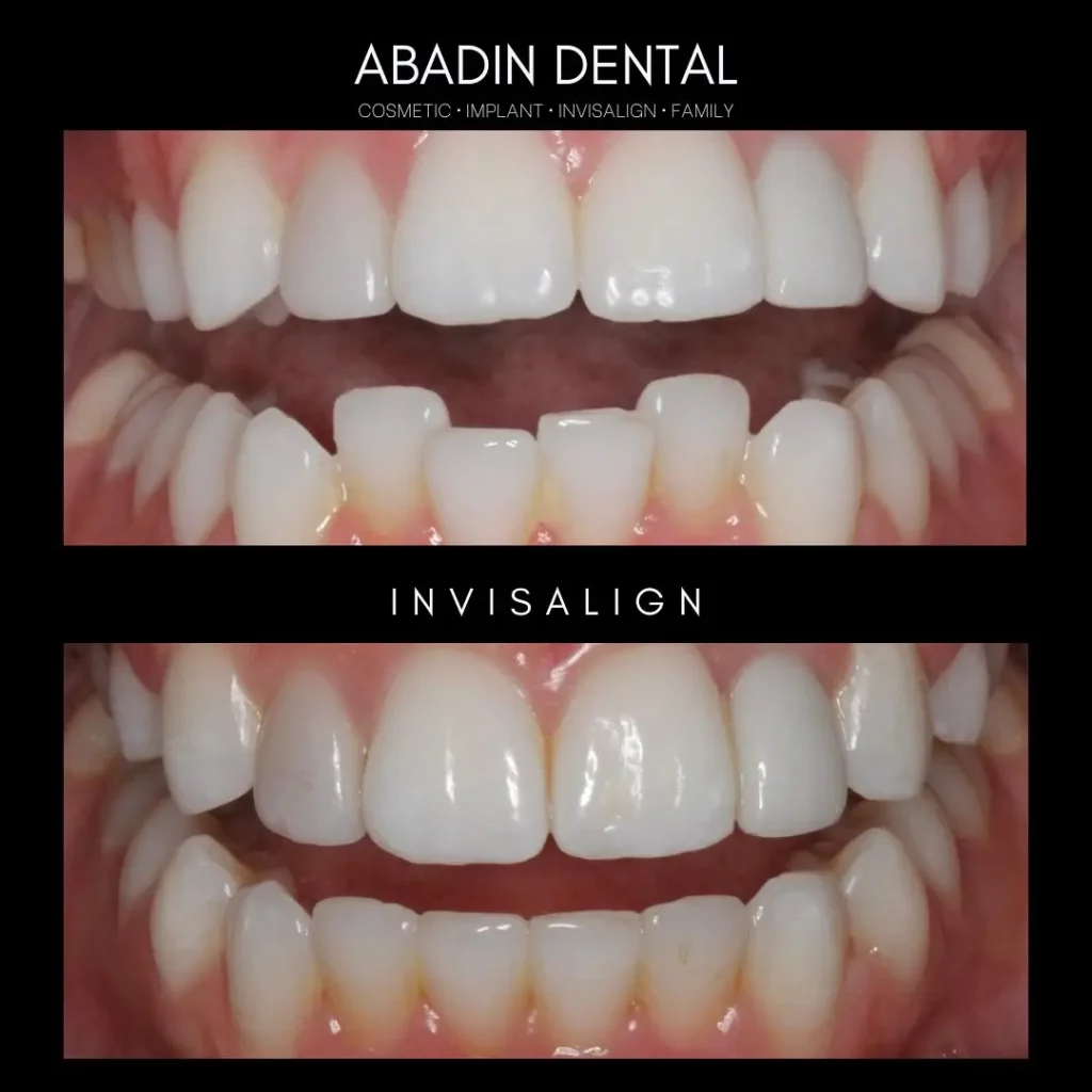 Invisalign Before and After