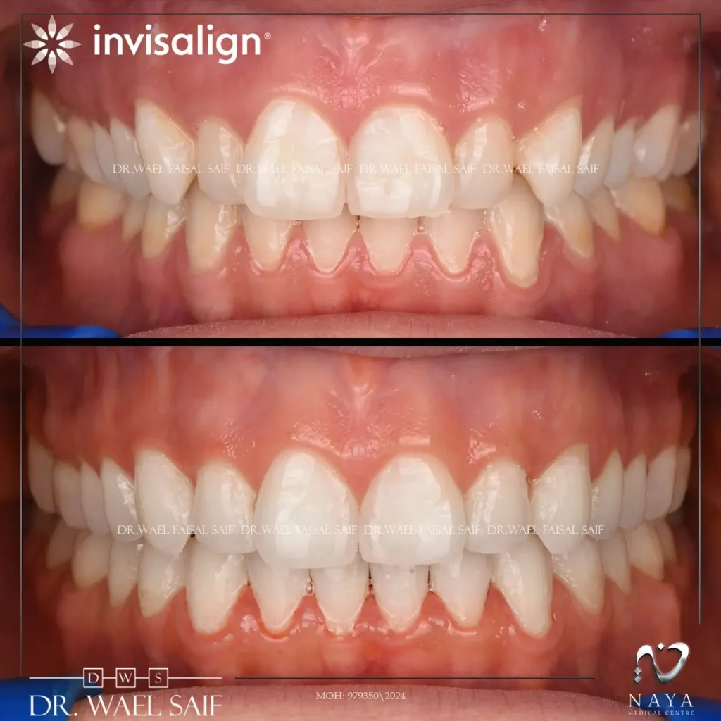 Invisalign Before and After