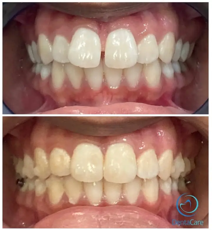 Invisalign Before and After