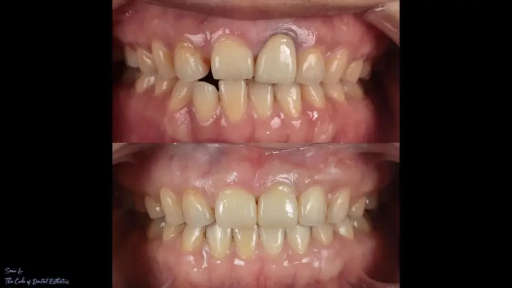 Invisalign Before and After