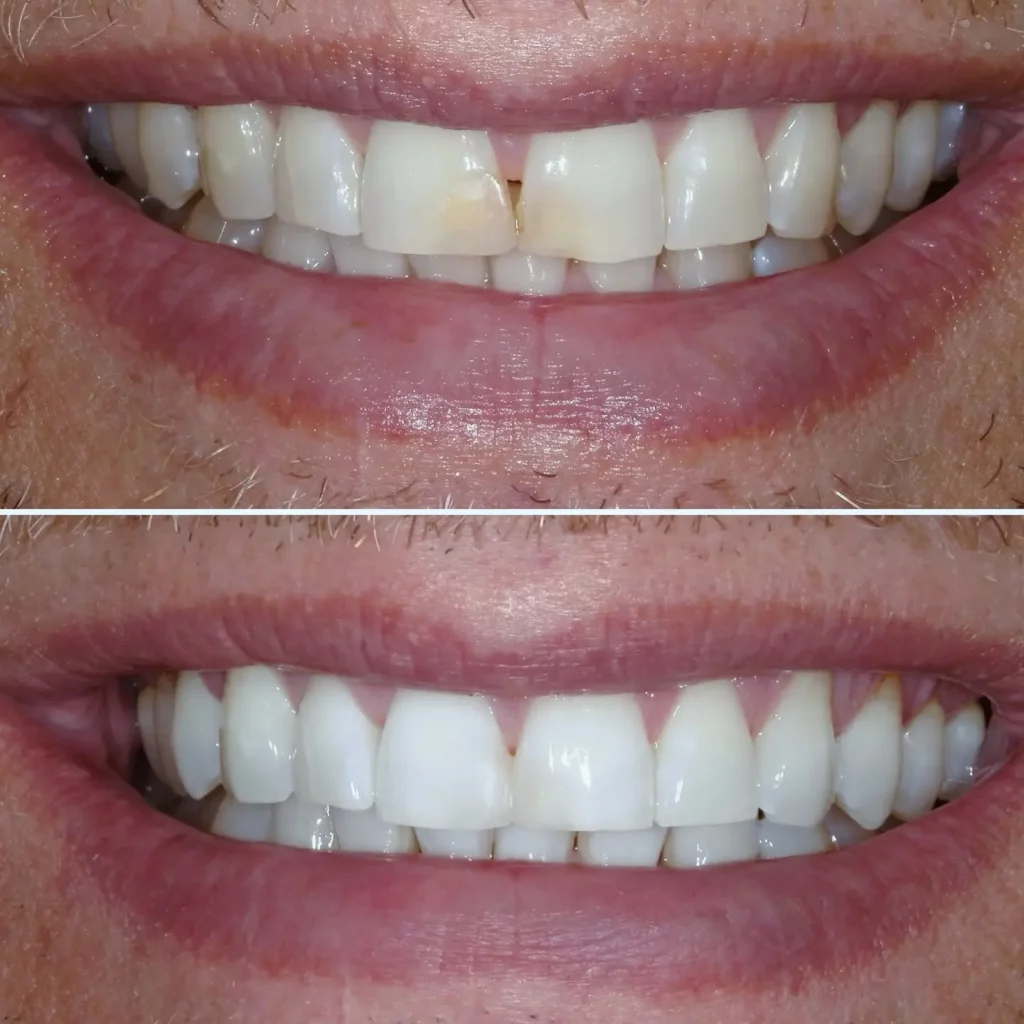 Invisalign Before and After