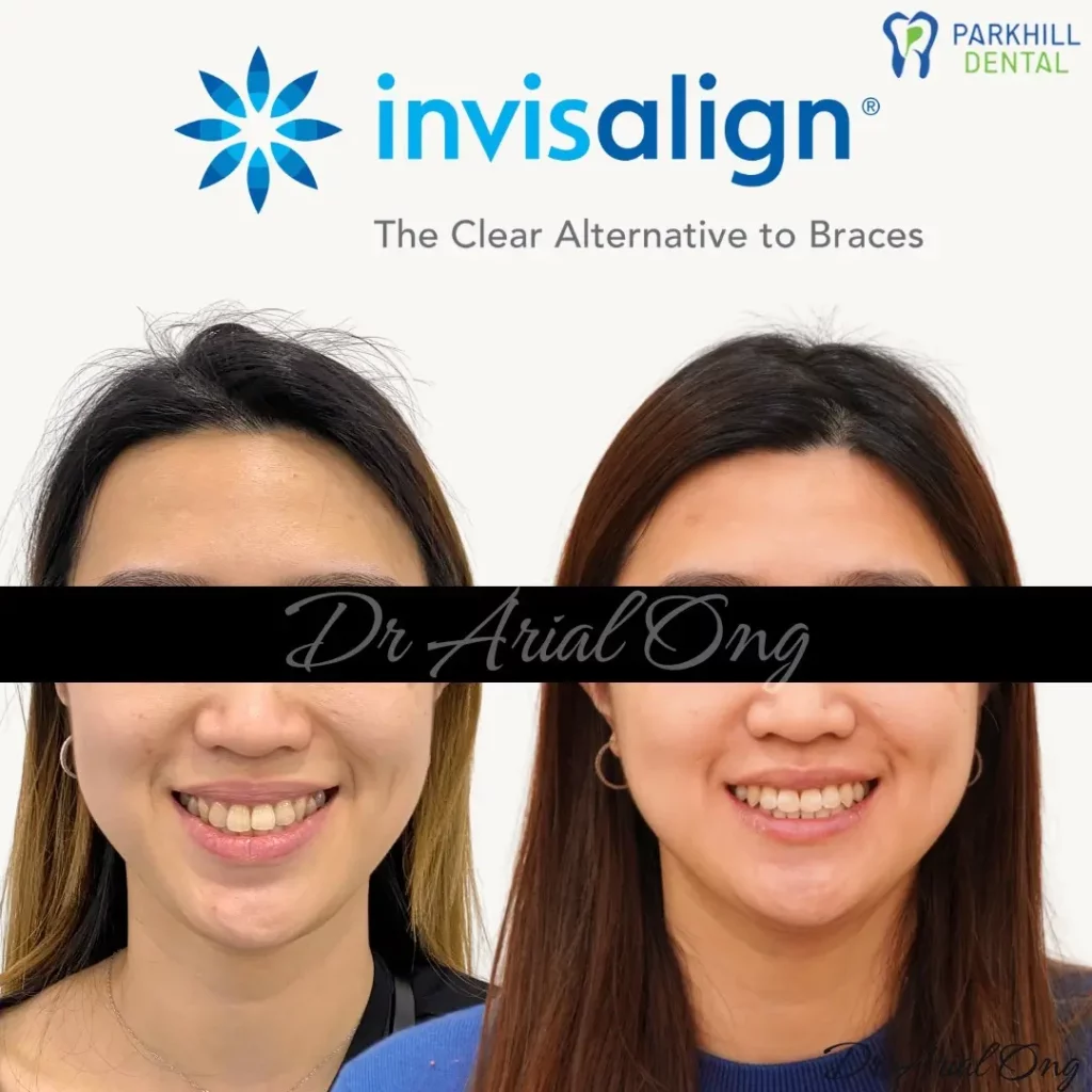 Invisalign Before and After