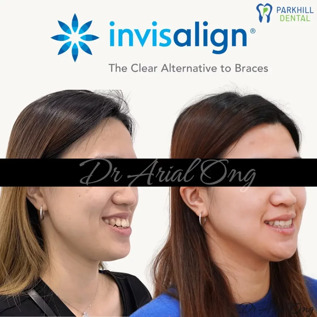 Invisalign Before and After