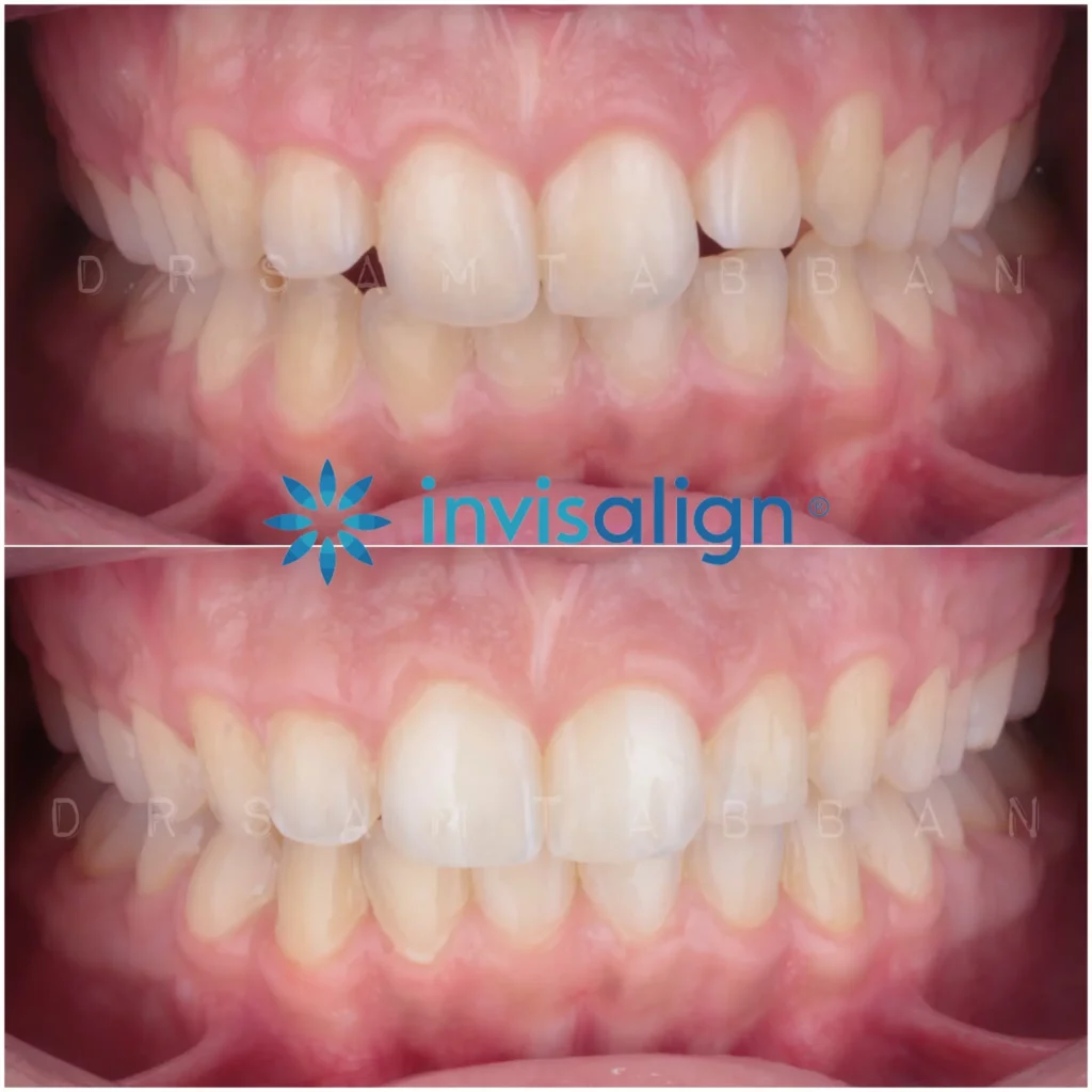 Invisalign Before and After