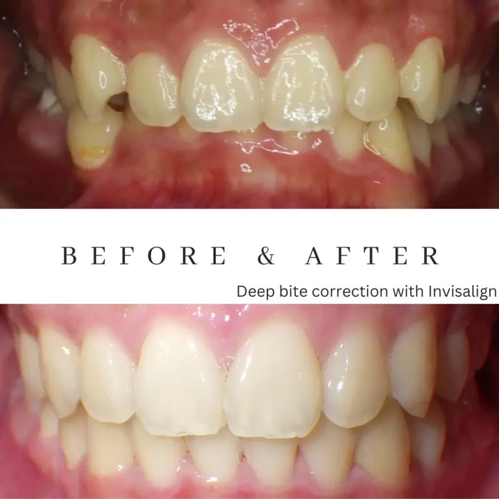 Invisalign Before and After