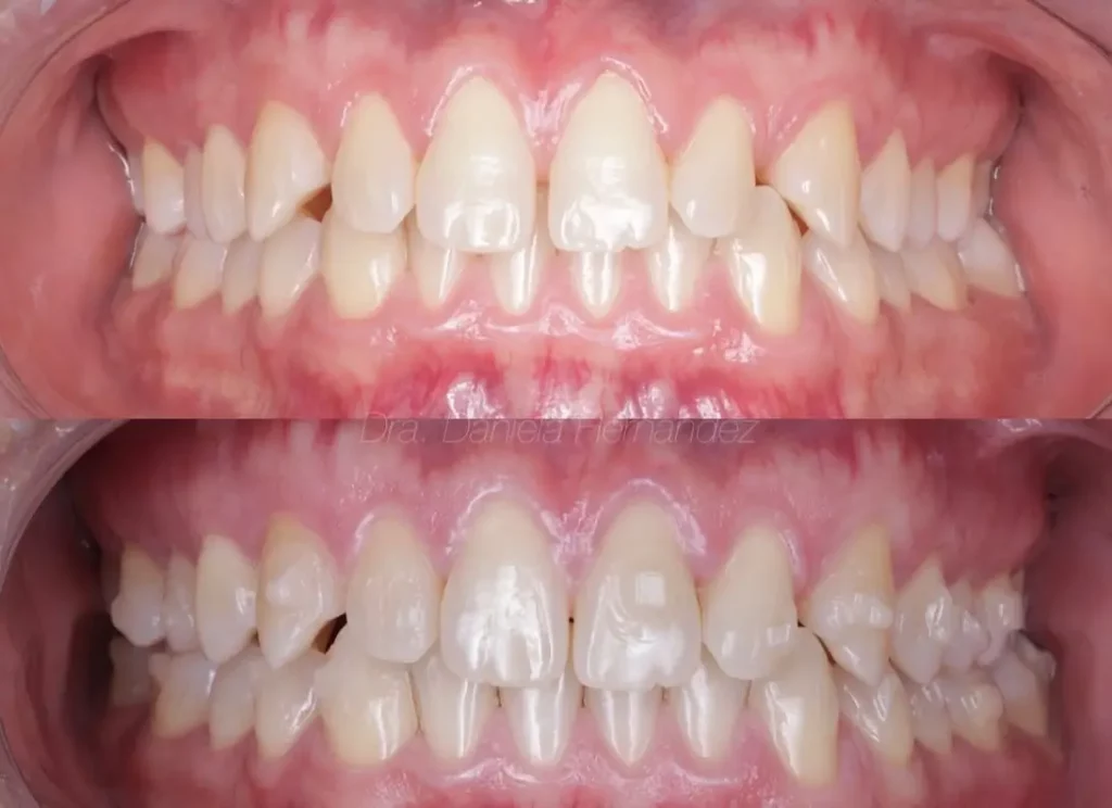 Invisalign Before and After