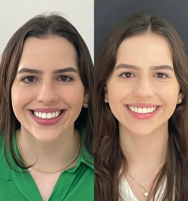 Invisalign Before and After