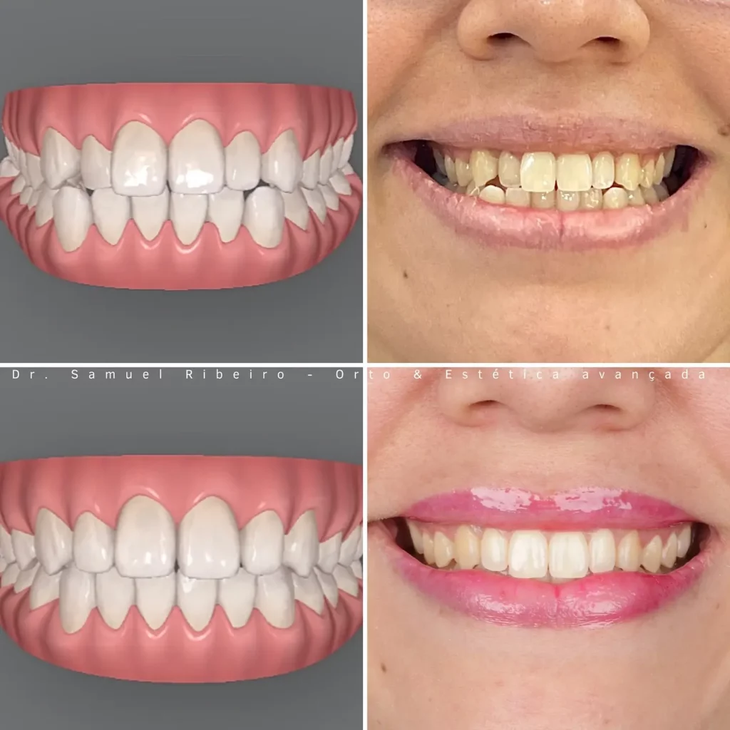 Invisalign Before and After