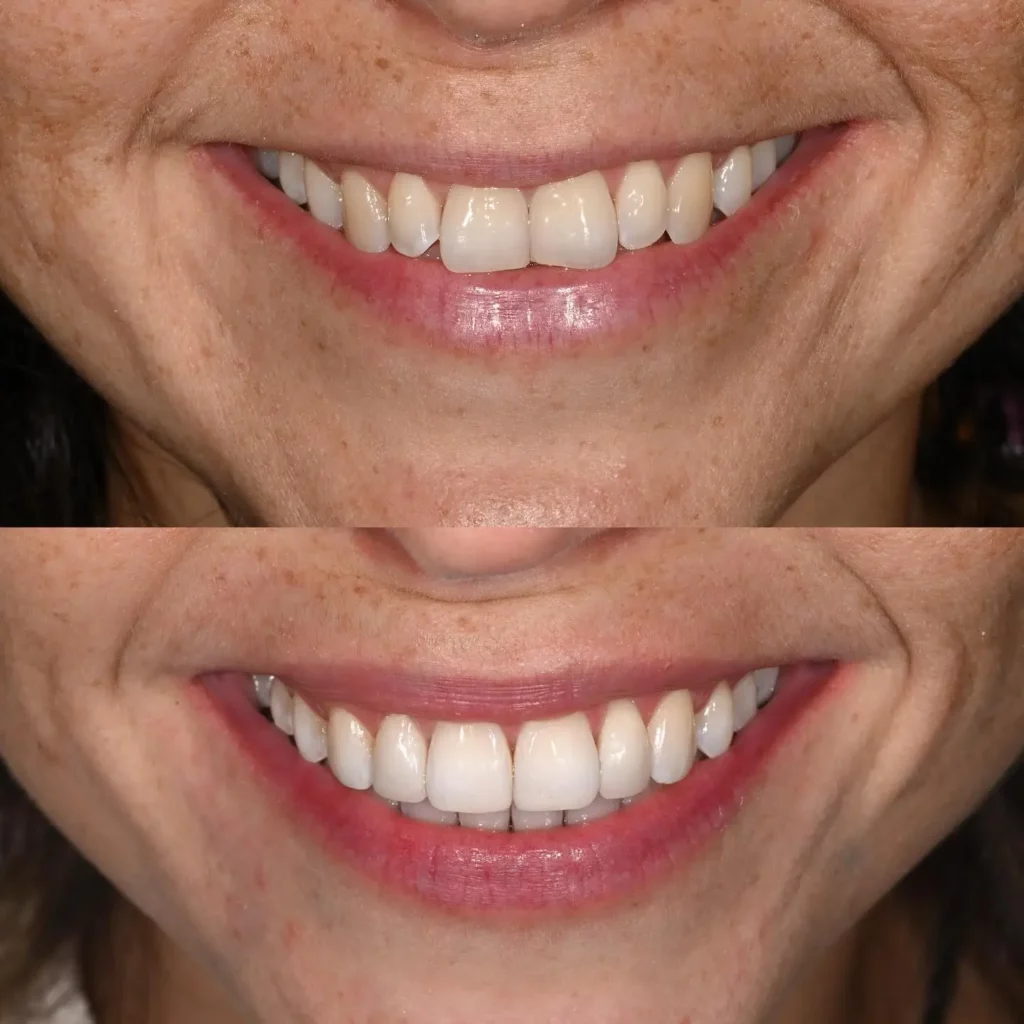 Invisalign Before and After