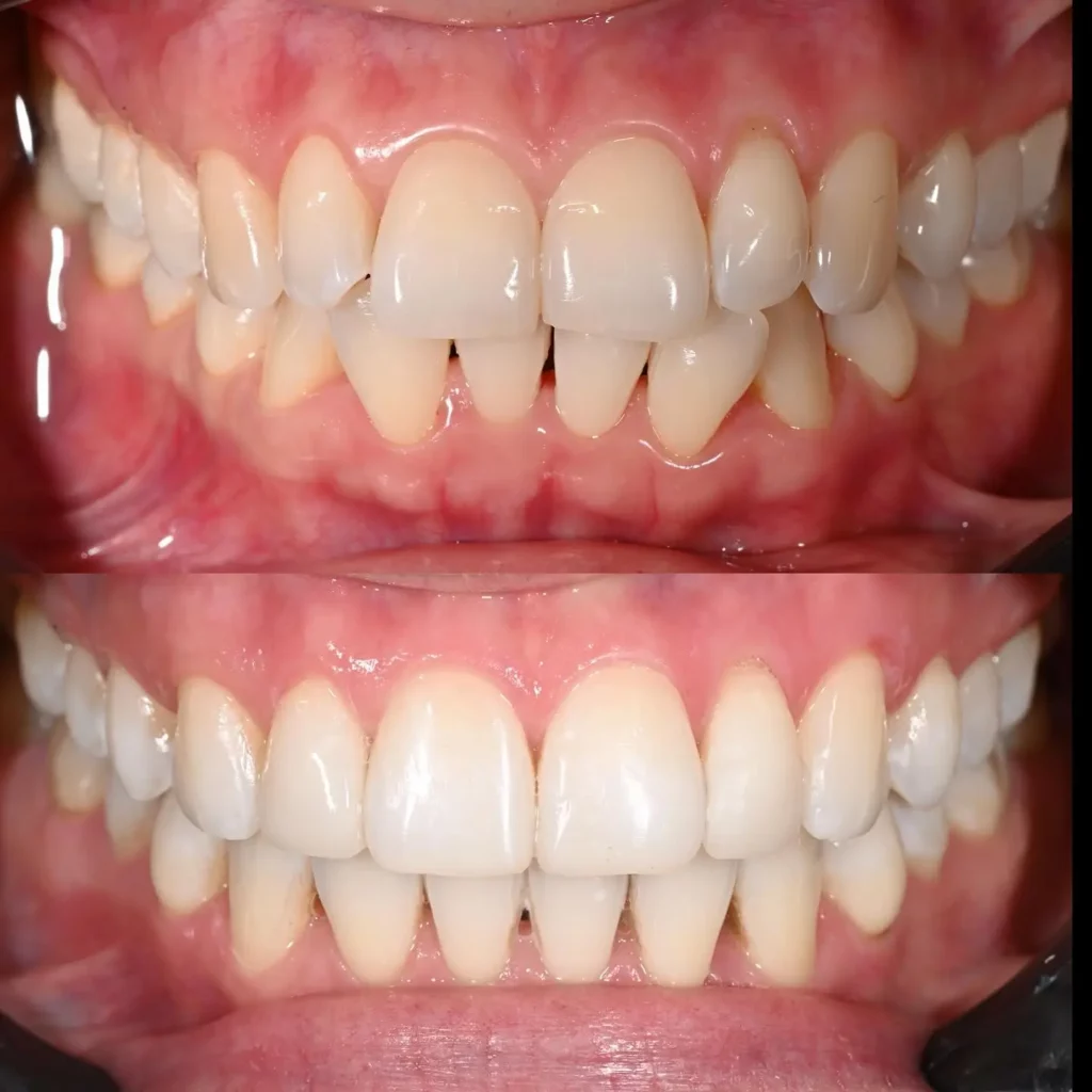 Invisalign Before and After