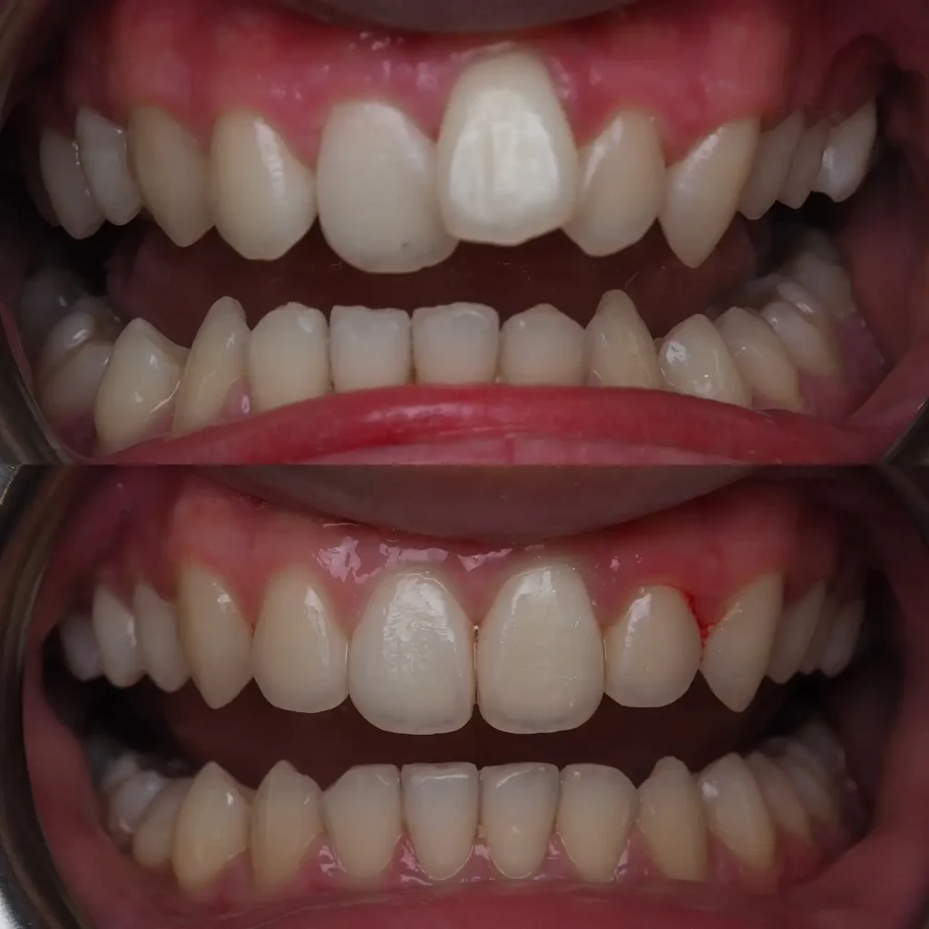 Invisalign Before and After