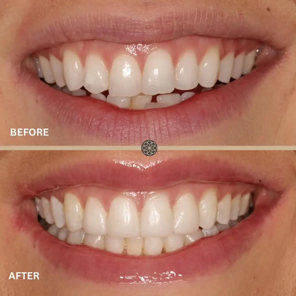 Invisalign Before and After