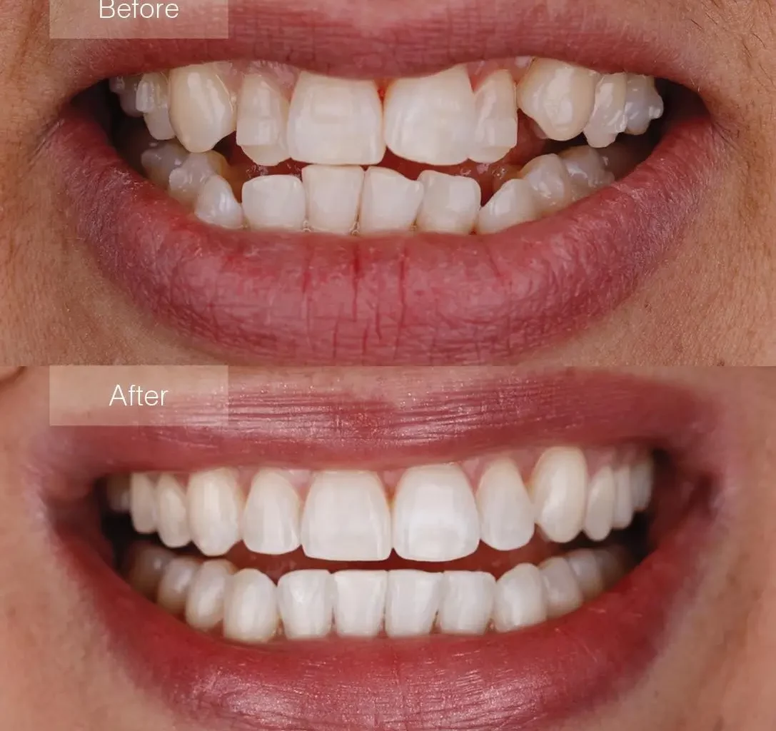 Invisalign Before and After