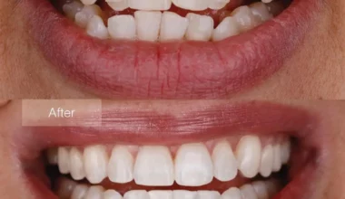 Invisalign Before and After