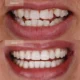 Invisalign Before and After