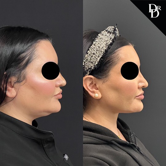 Kybella Before and After