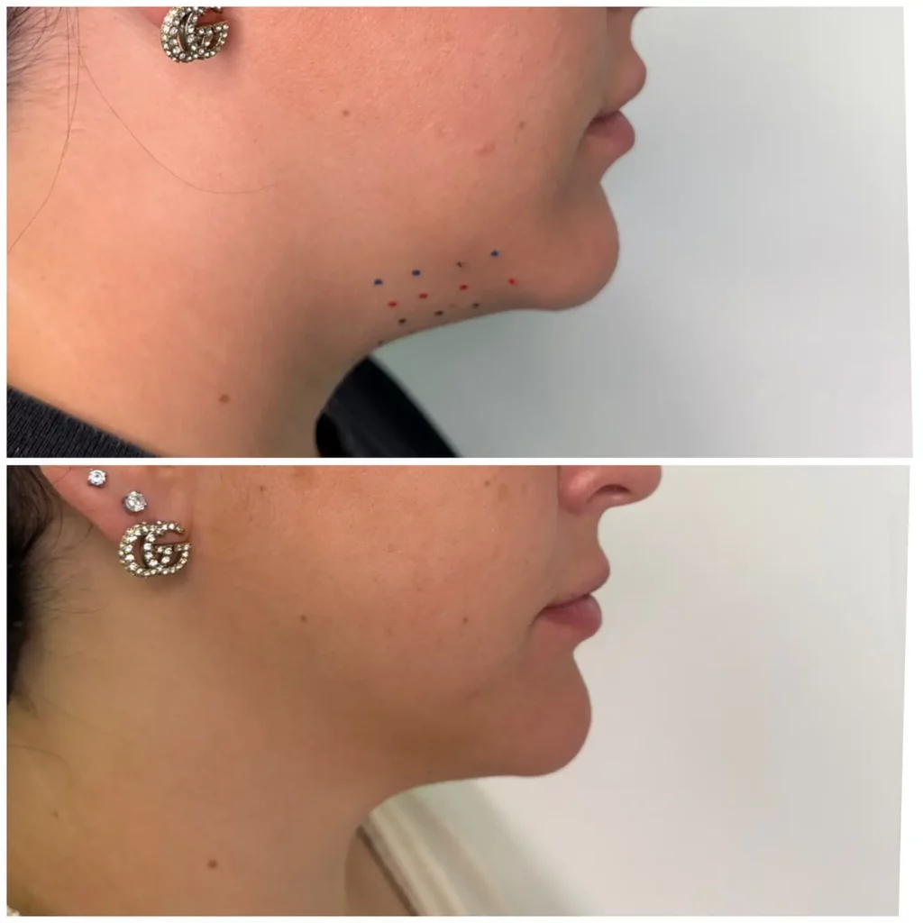 Kybella Before and After