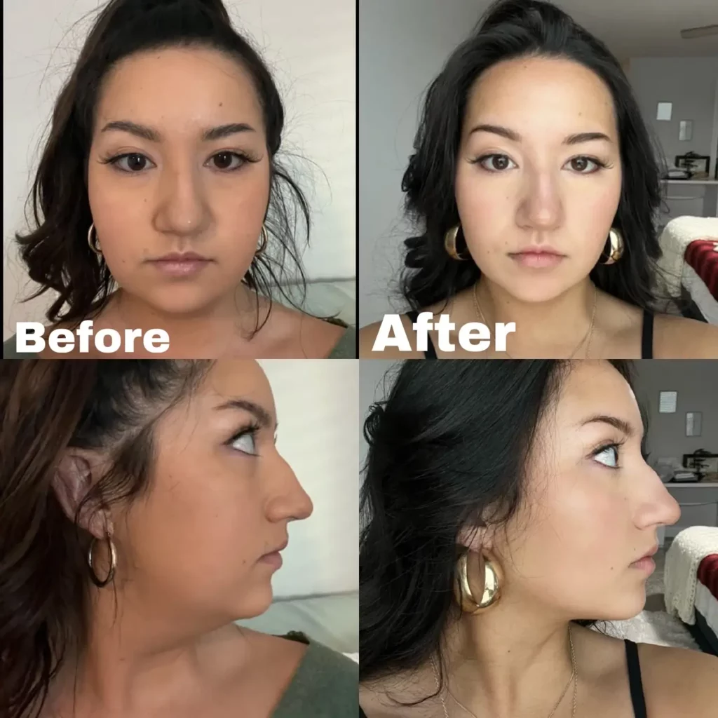 Kybella Before and After