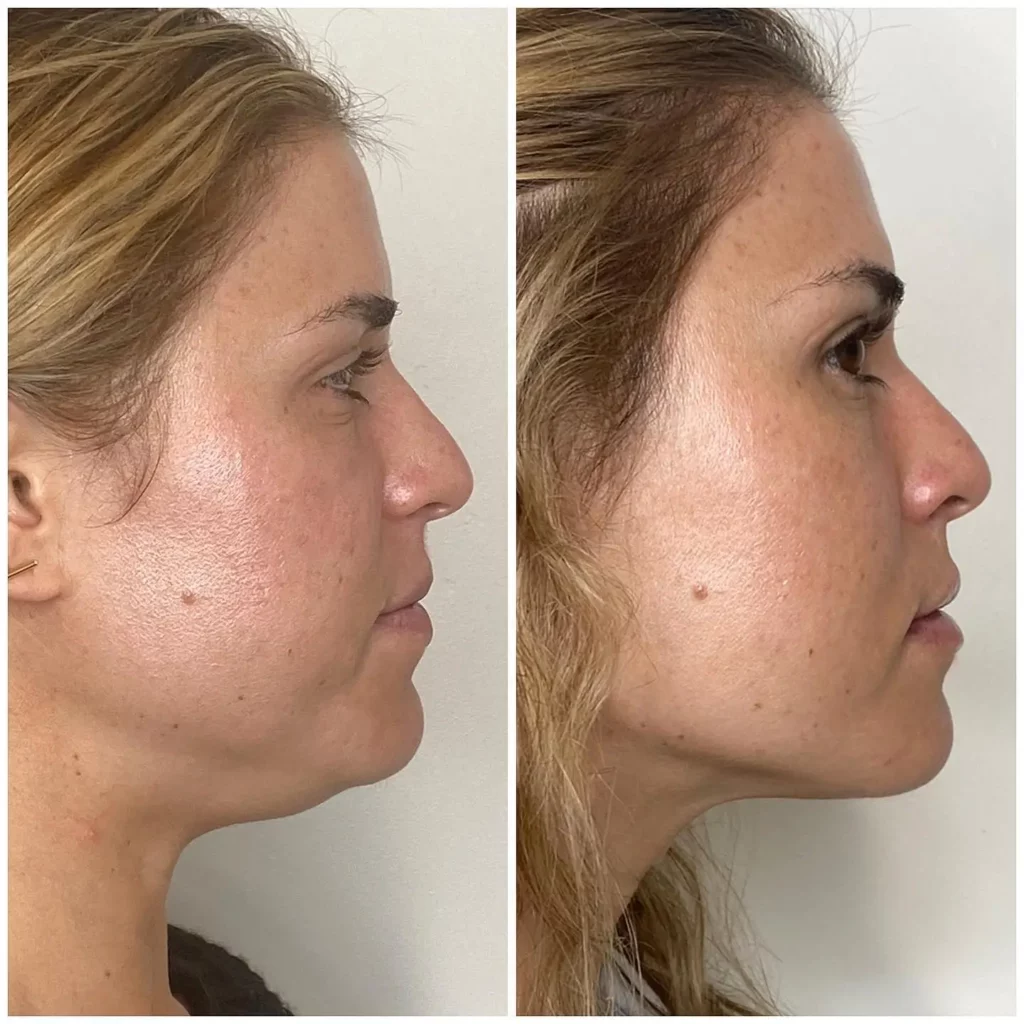 Kybella Before and After