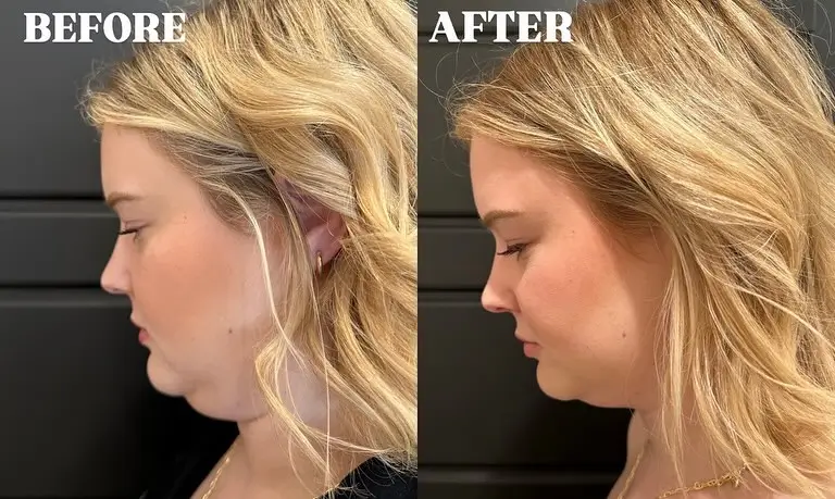 Kybella Before and After