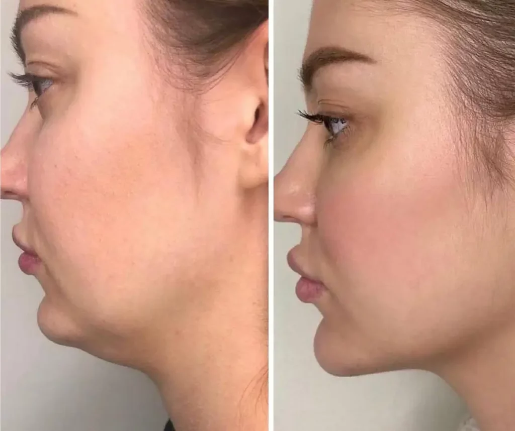 Kybella Before and After