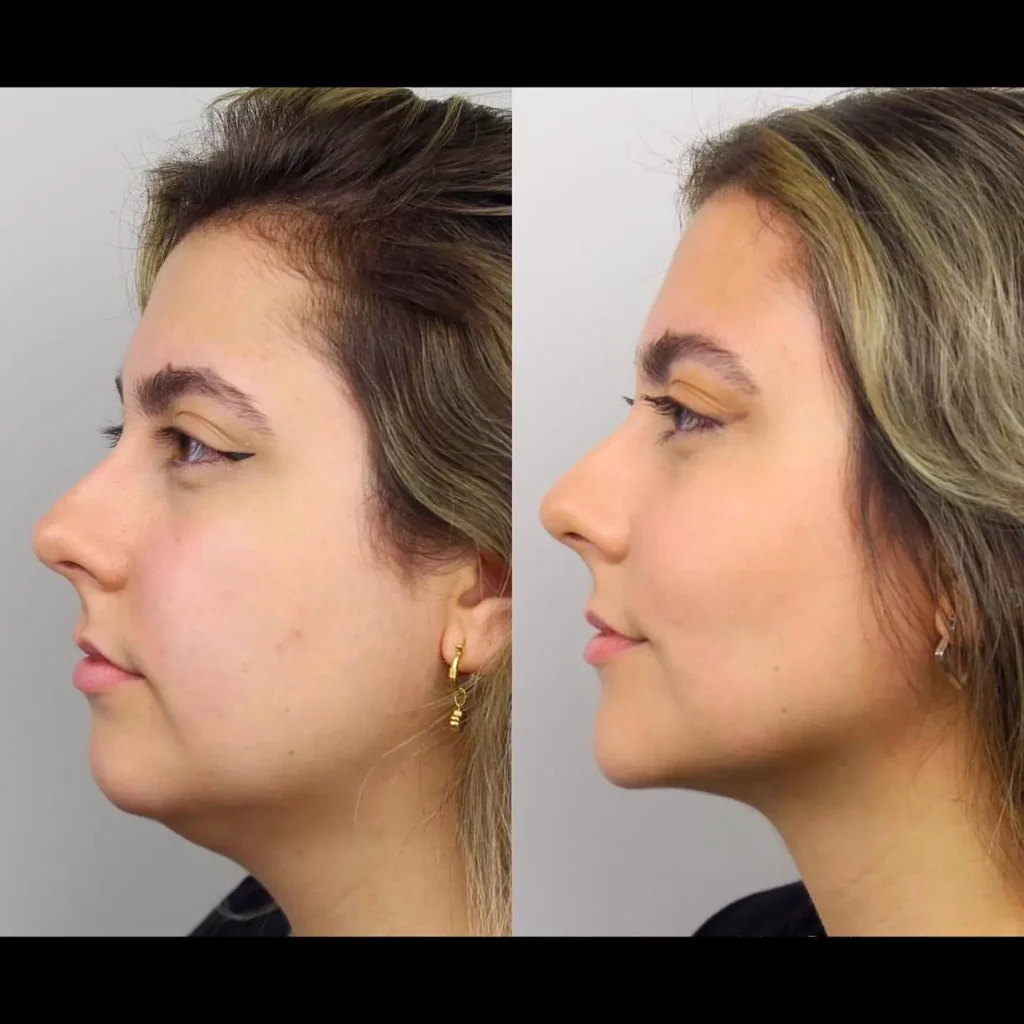 Kybella Before and After