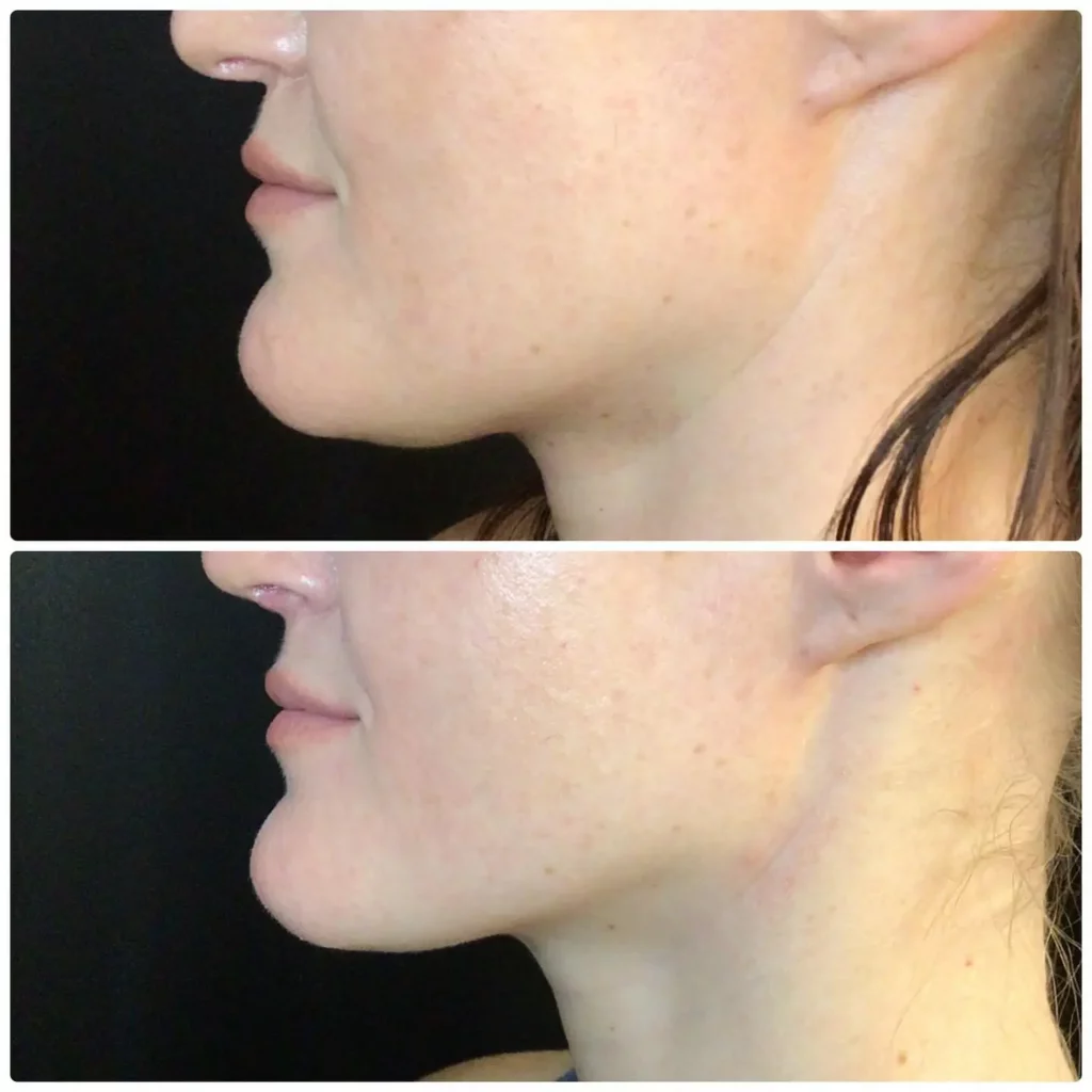 Kybella Before and After