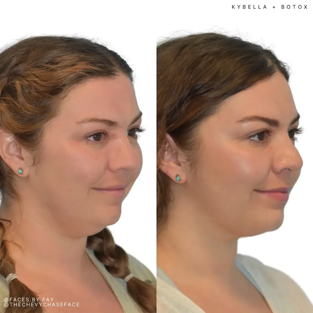 Kybella Before and After