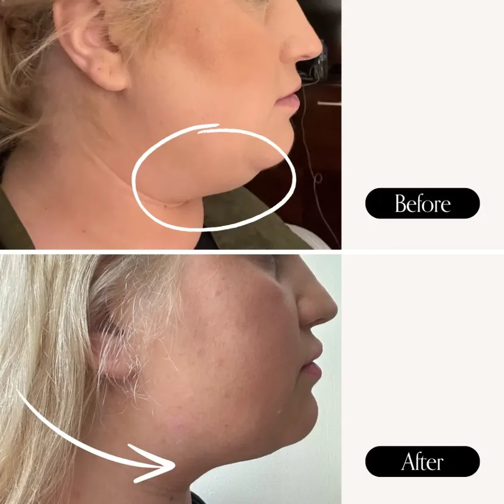 Kybella Before and After