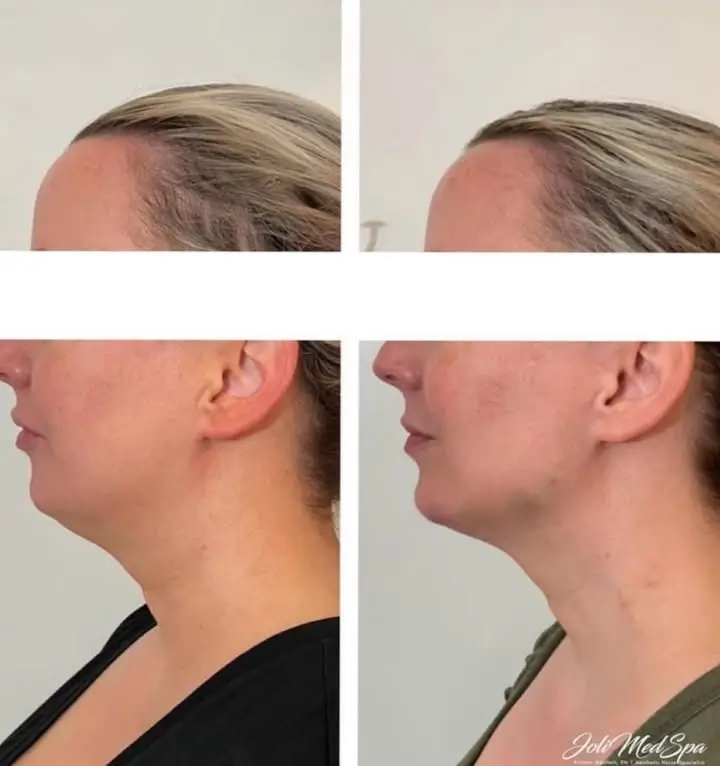 Kybella Before and After