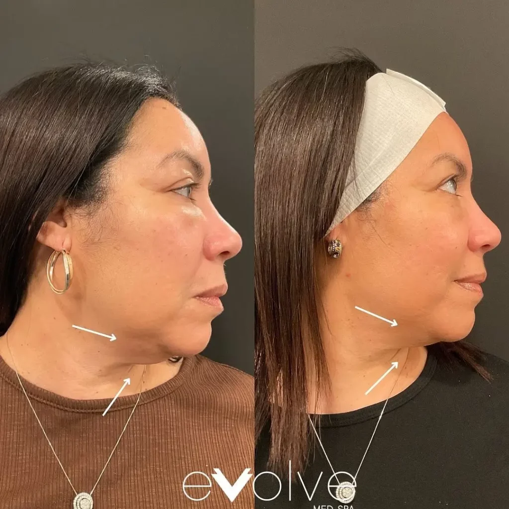 Kybella Before and After