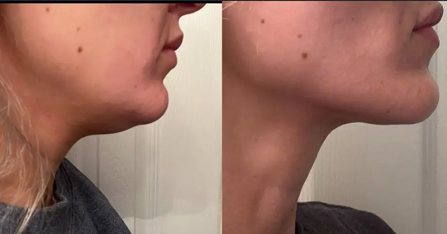 Kybella Before and After