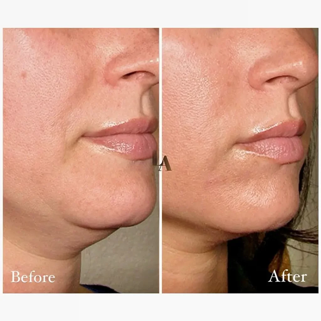 Kybella Before and After