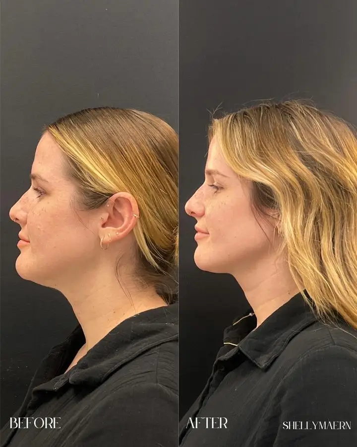 Kybella Before and After