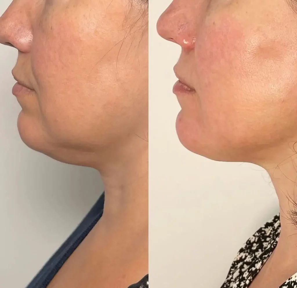 Kybella Before and After