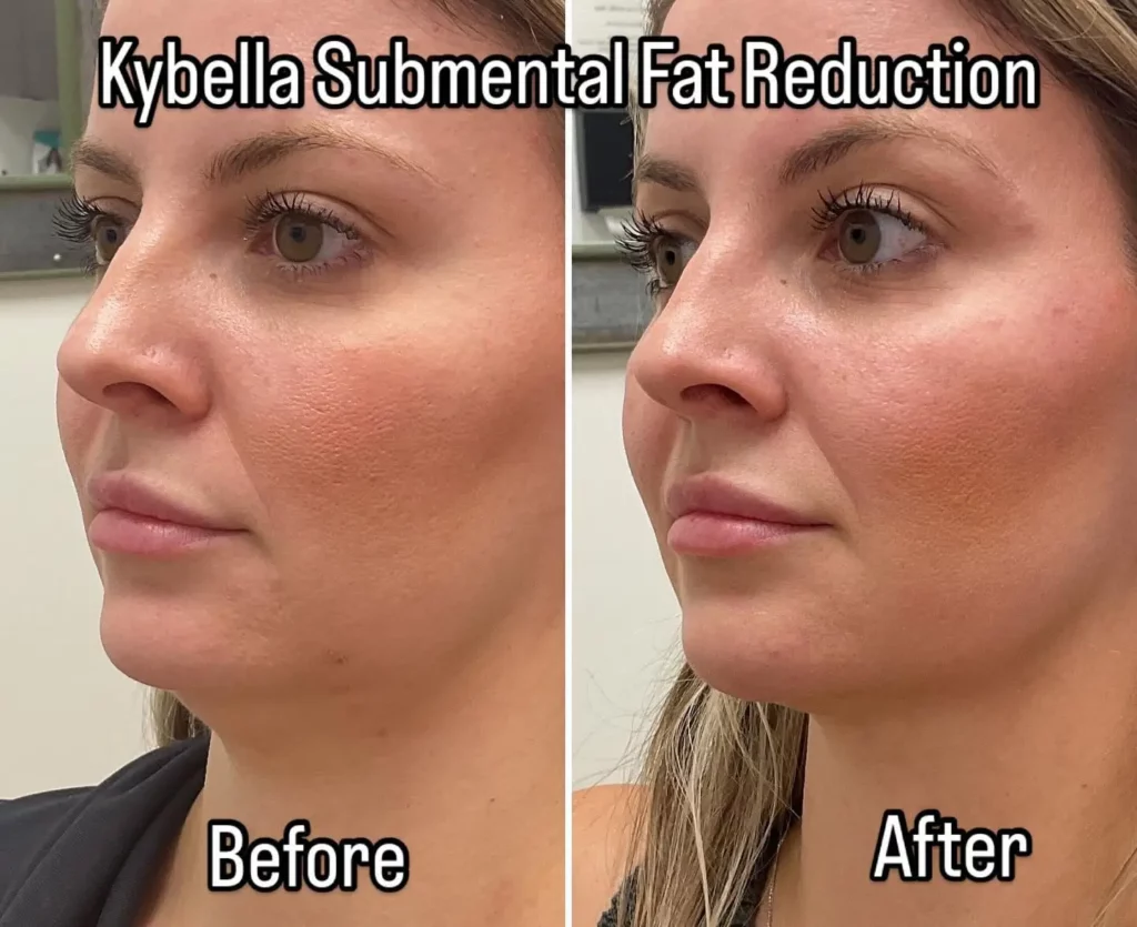 Kybella Before and After