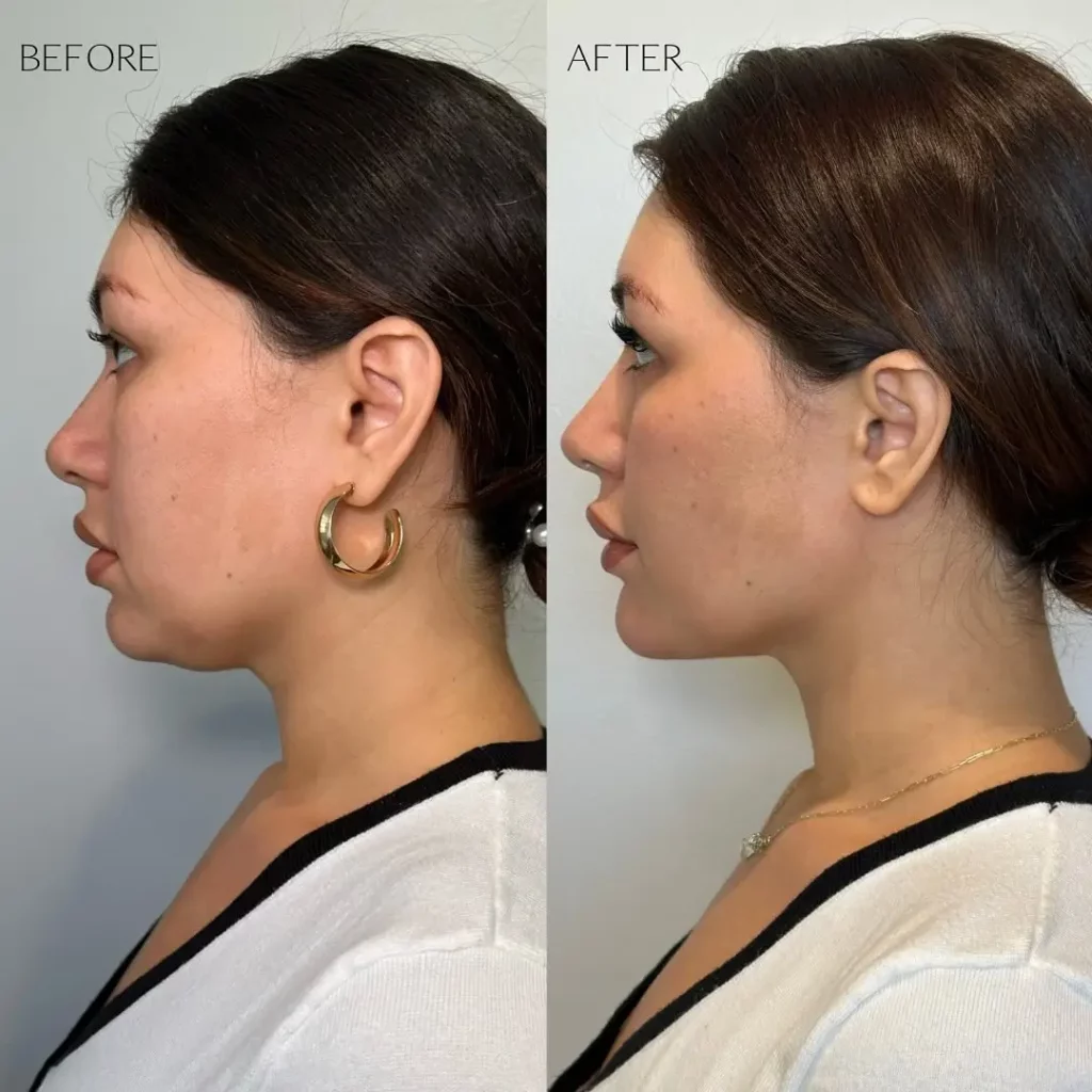 Kybella Before and After