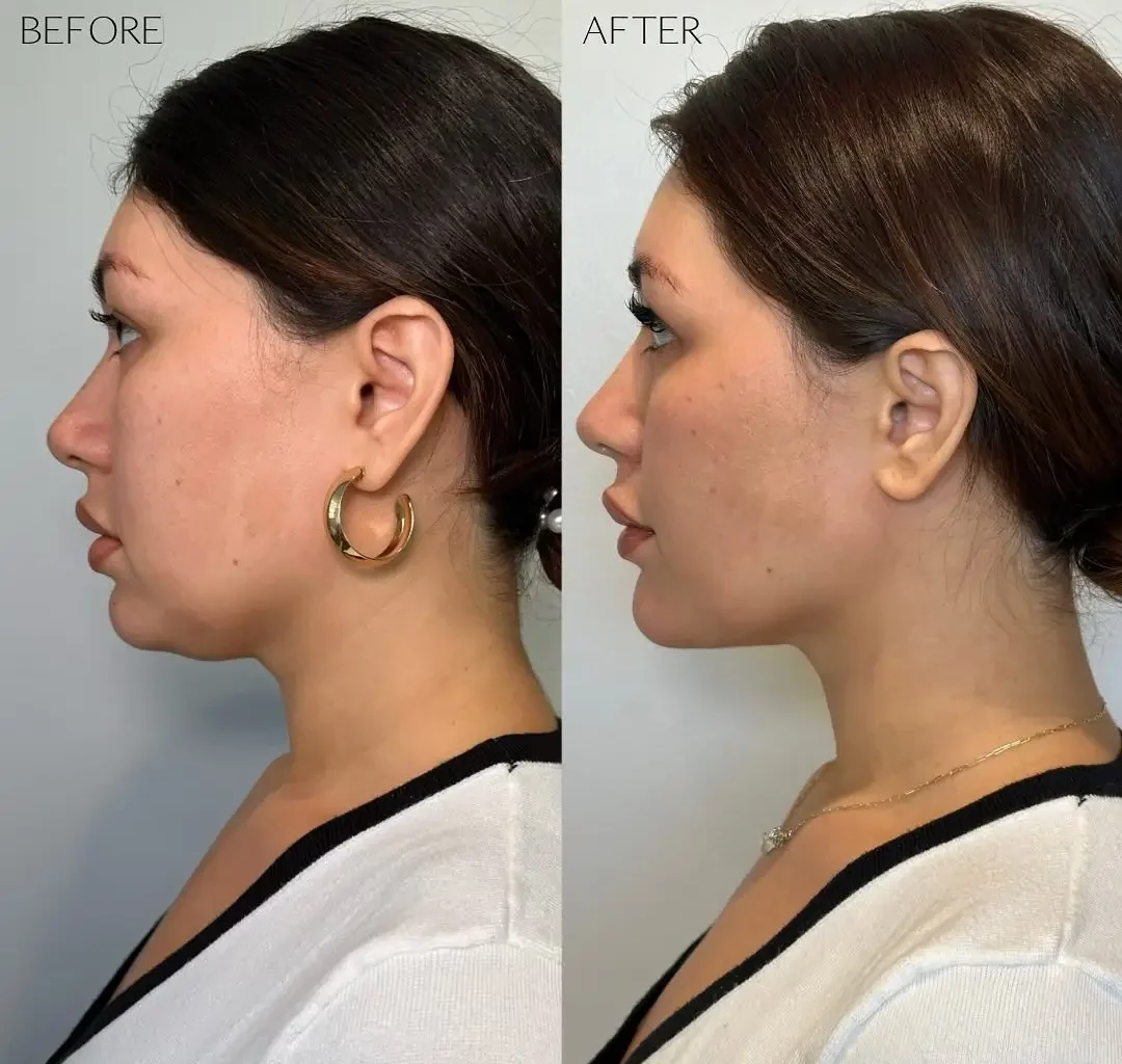 Kybella Before and After