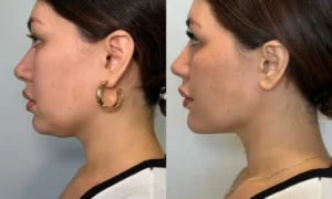 Kybella Before and After