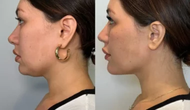 Kybella Before and After