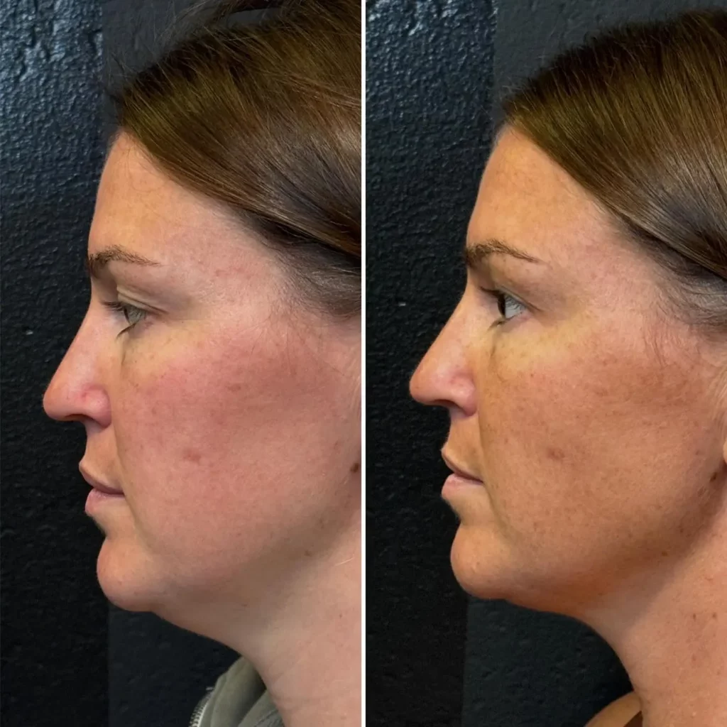 Kybella Before and After