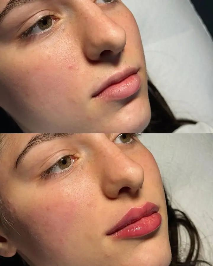 Lip Filler Before and After