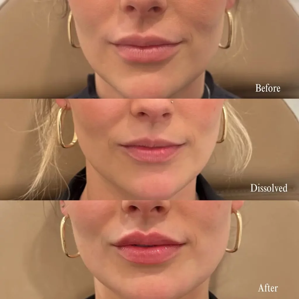 Lip Filler Before and After