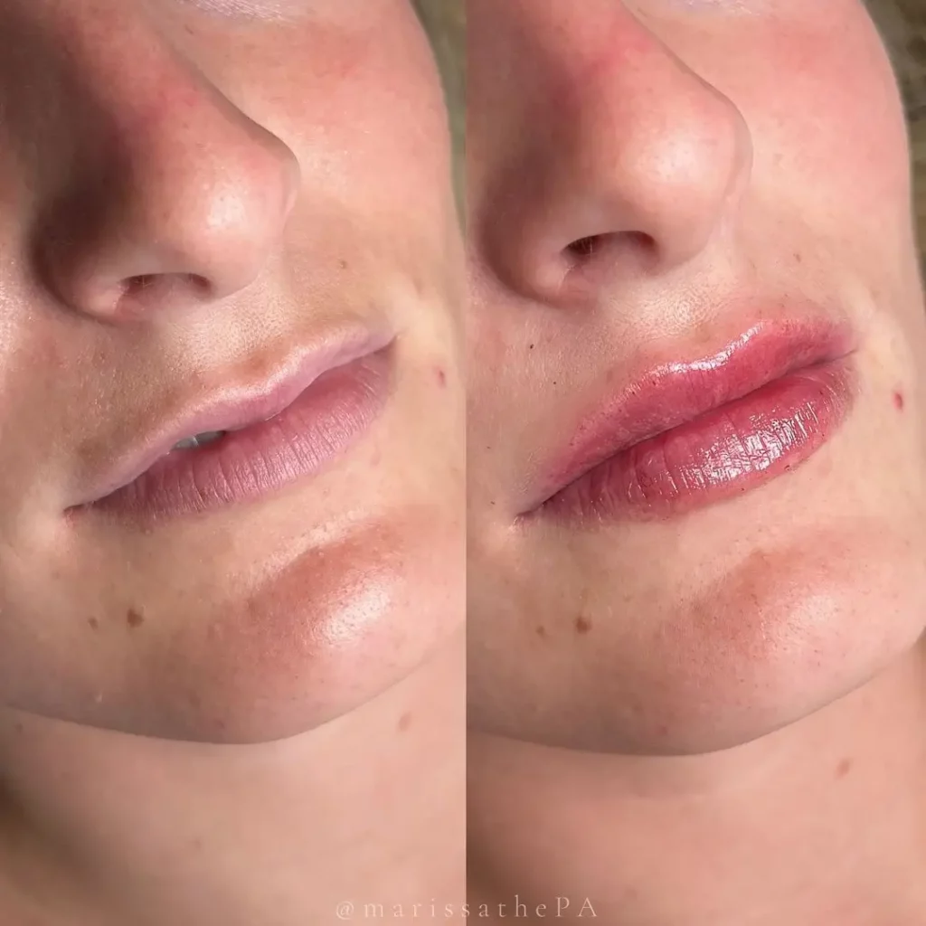 Lip Filler Before and After