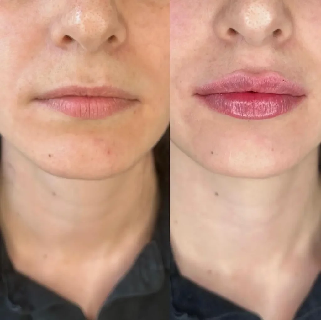 Lip Filler Before and After