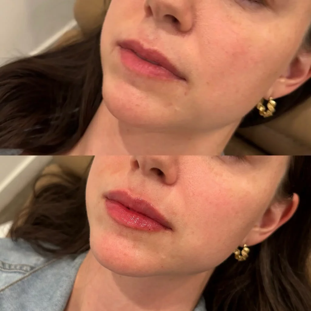 Lip Filler Before and After