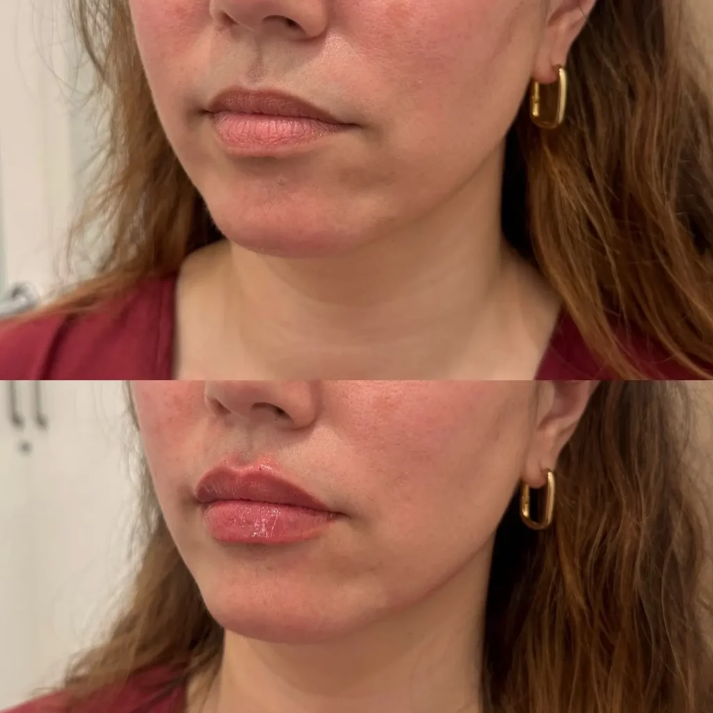 Lip Filler Before and After